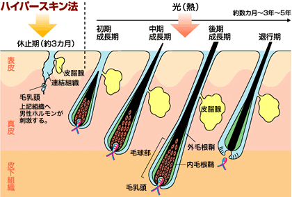 ハイパースキン脱毛方